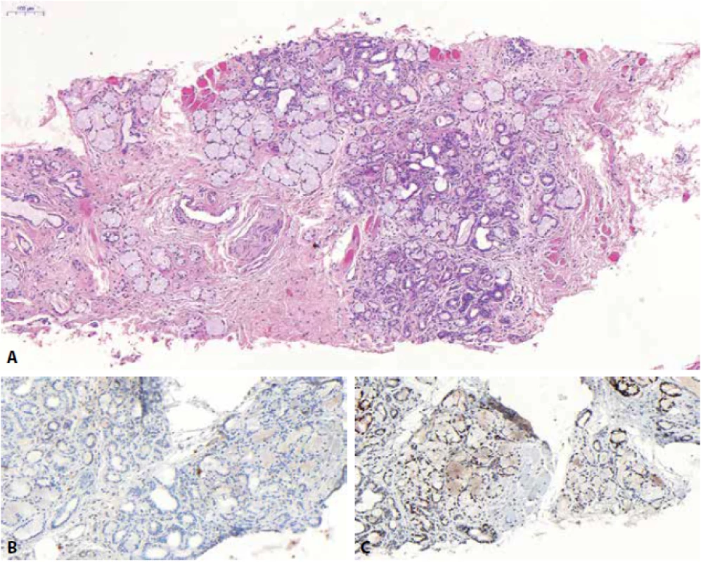 Cowperovy žlázky jsou spíše morfologická než imunohistochemická diagnóza, na lézi tak třeba též především myslet. Jsou tvořeny glandulárními strukturami, které připomínají mucinózní slinné žlázky. Současně jsou přítomny i morfologicky odlišné exkrečním duktům podobné struktury a v okolí bývají vlákna příčně pruhované svaloviny (A). V literatuře se údaje o pozitivitě PSA (B) v Cowperových žlázkách výrazně rozcházejí, proto je lepší se barvení raději vyhnout. NKX3.1 je ve žlázkách pozitivní (C).
