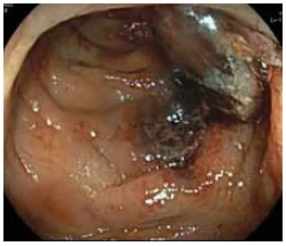 Zánětlivé postižení tlustého
střeva v oblasti sestupného tračníku. <br> 
Fig. 2. Infl ammatory involvement of
the large intestine in the area of the
descending colon.