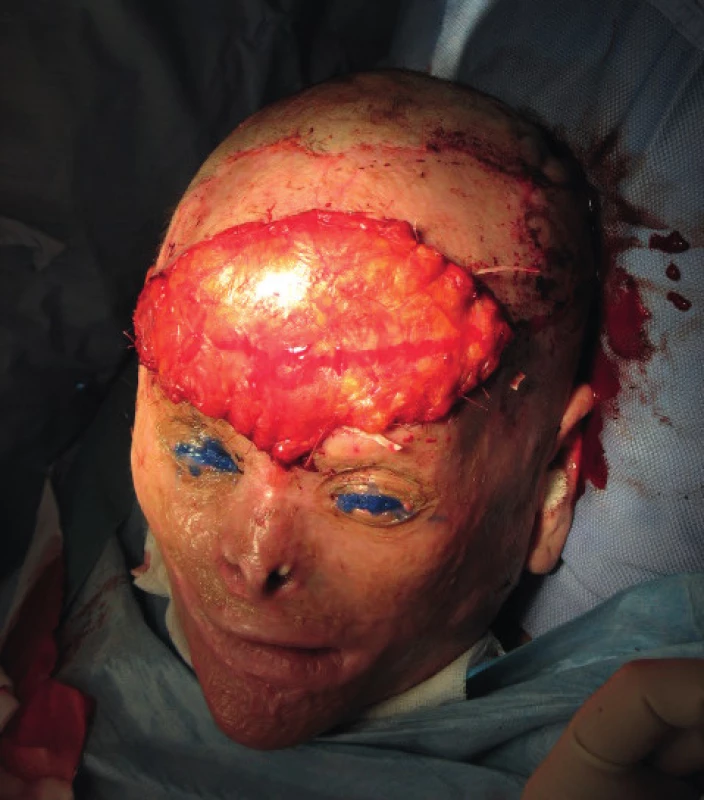 Closure of the defect with free flap transfer using the
serratus anterior muscle
