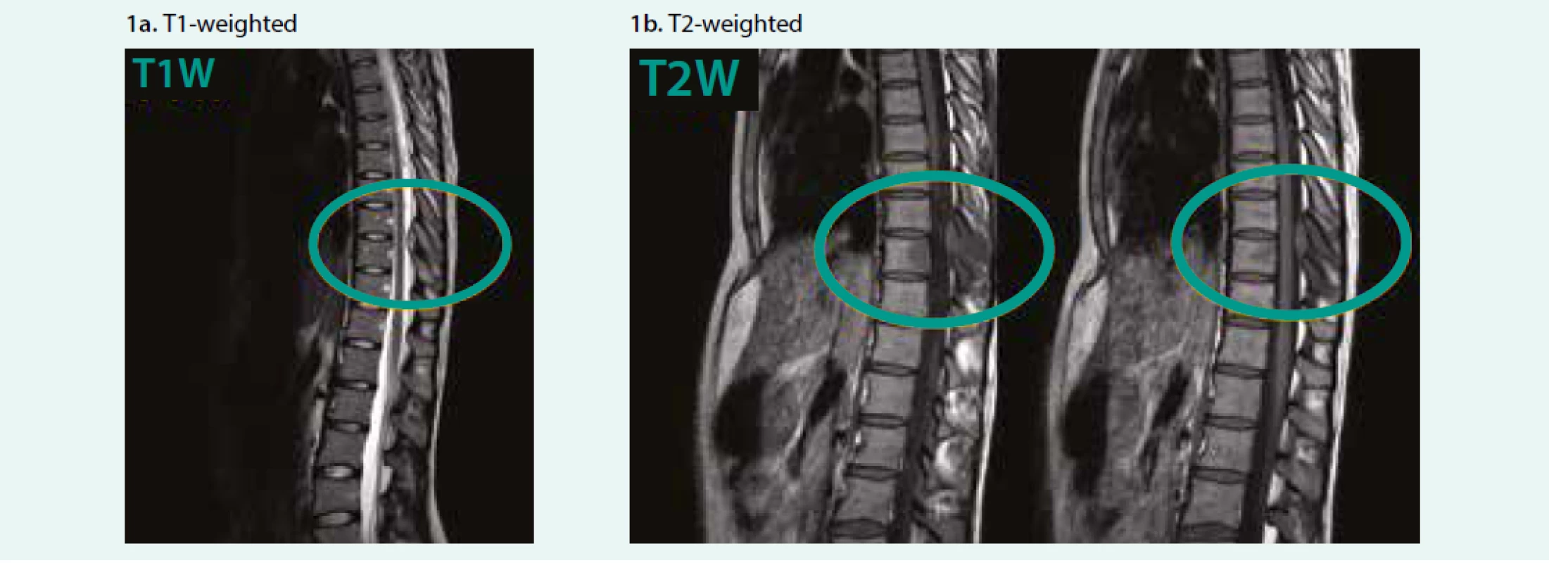 MRI – the SEA in thoracic spine, sagital scan. Department of Radiology, and Nuclear Medicine