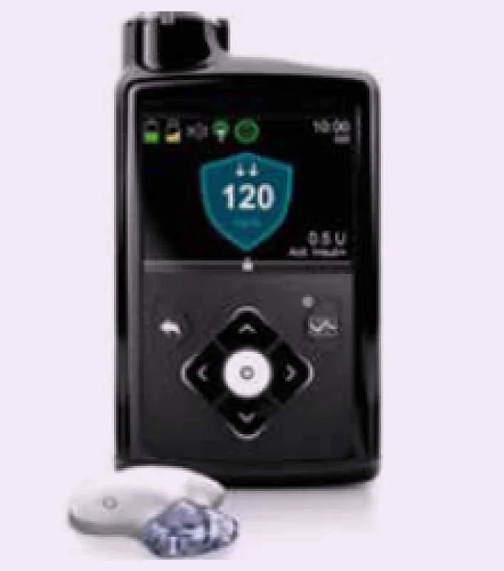 Prvý systém s automatickým dávkovaním
bazálneho inzulínu na základe merania
glukózy CGM systémom (Medtronic
MiniMed 670G). Automatické dávkovanie je
možné iba pre bazálny inzulín, kým bolusový
inzulín si podáva pacient sám (tzv. hybridný
systém)