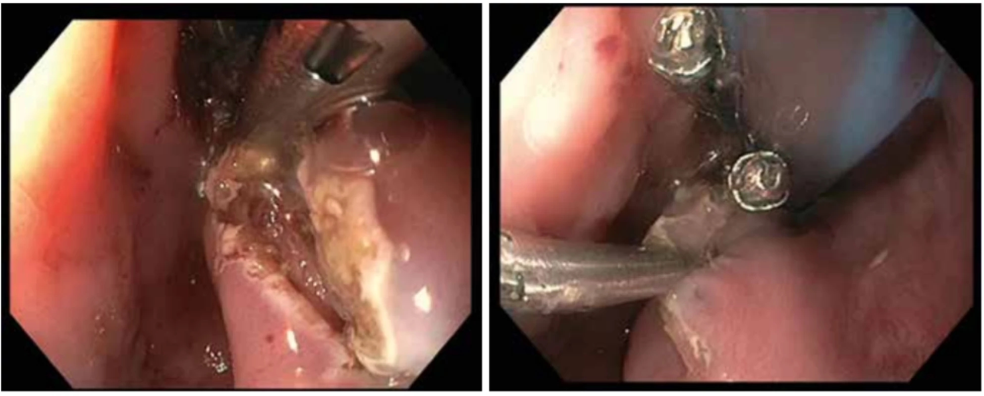 Hemoklipy na spodině septa po myotomii
Zdroj: Archiv Odd. gastrointestinální endoskopie ÚVN v Praze<br>
Fig. 4: Hemoclips at the bottom of the septum after myotomy
Source: Archive of Gastrointestinal Endoscopy Department of the Military University Hospital in Prague
