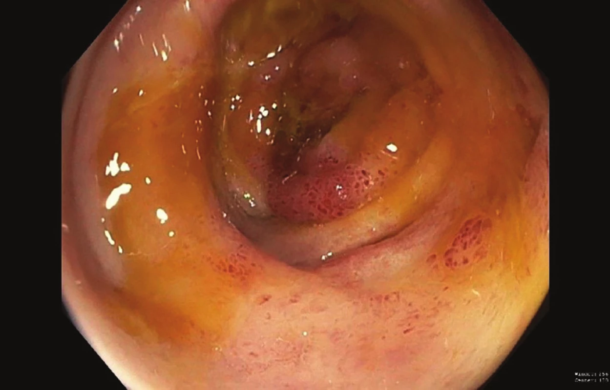 Ischemické vředy na pravém tračníku (kolonoskopie)<br>
Fig. 3: Ischemic right colon ulcers (colonoscopy)