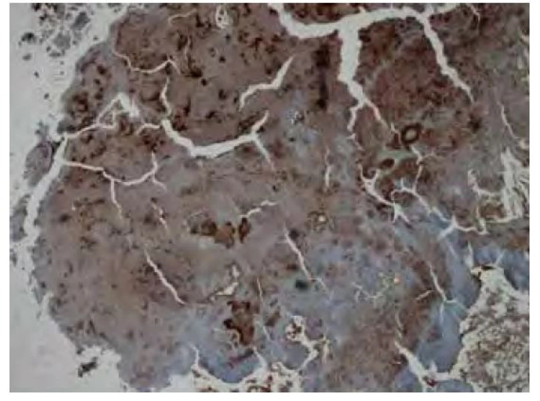 Imunohistochemické vyšetření v reakci s protilátkou proti
transthyretinu vykazuje nepravidelnou fokální převážně středně silnou
pozitivitou amyloidu. Původní zvětšení snímku 40x