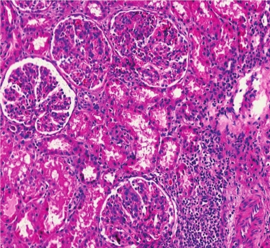 Histologický nález u pacientky č. 2.<br>Fig. 2. Histological findings in patient 2.