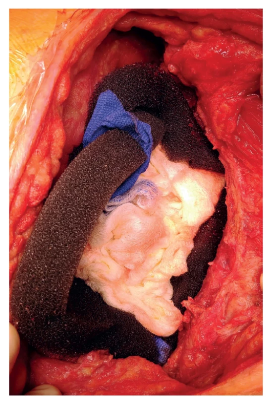 Vyplnění pleurální dutiny polyuretanovou houbou
po stěnách a plombáží rouškami uprostřed.<br>
Fig. 2: Pleural cavity filled with polyurethane sponge
along the walls and surgical drapes in the middle