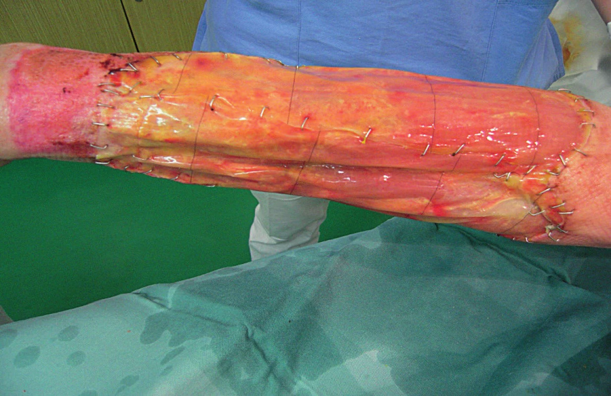 One month after Integra® application; changes of colour resulting from neovascularisation can be observed