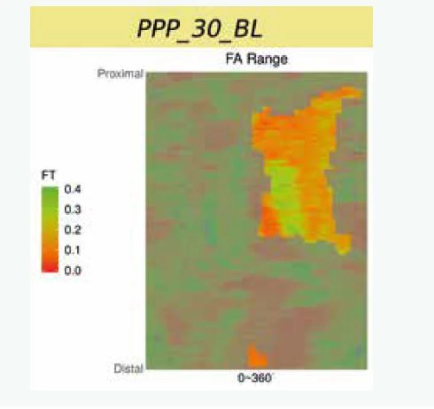 2D-rekonstrukce síly fibrózní čepičky
v plátech v celém vyšetřeném segmentu tepny.
Koronární tepna je zobrazena jako „rozbalený
koberec“, na ose „x“ je cirkumferenciální informace
(0-360 stupňů) a na ose „y“ longitudinální
informace (proximálně-distálně). Archiv autora