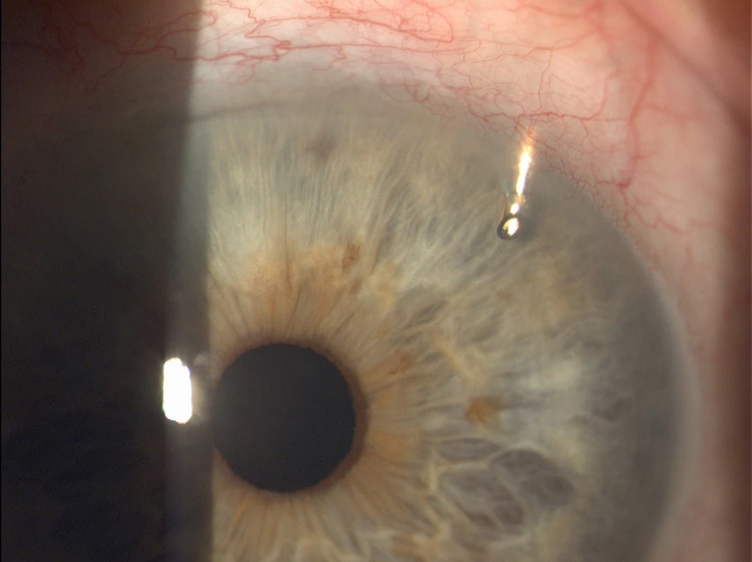 EX-PRESS implant located in the upper outer quadrant of the
left eye (Source: own processing, year: 2015)