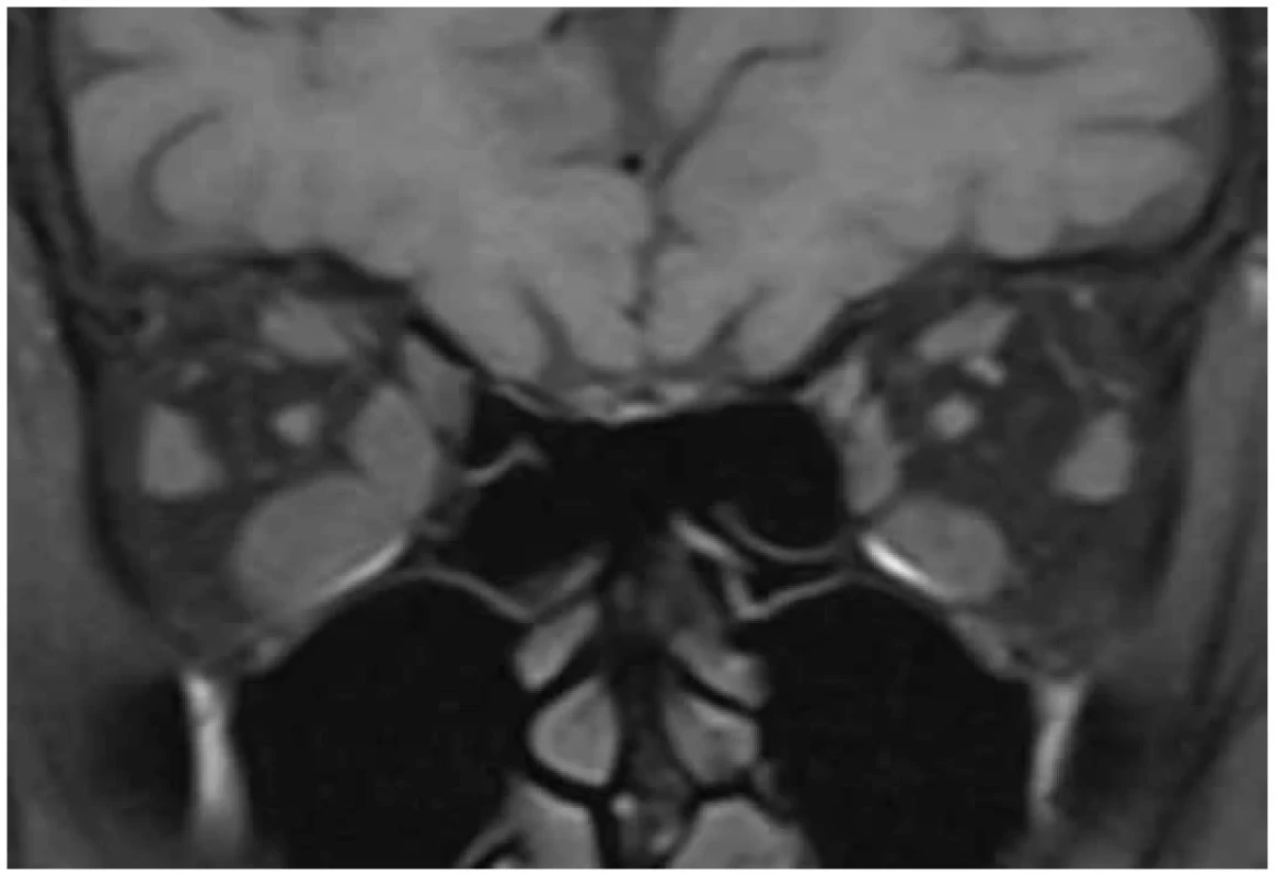 Magnetic resonance – coronal image at the level of orbits of a patient with thyroid-
-associated orbitopathy, fat-suppressed nonenhanced T1-weighted image: bilateral intraocular
muscles enlargement more pronounced on right side