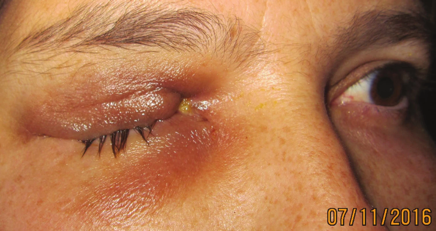 Patient after reduction of tumor masses in the orbit in
11/2016