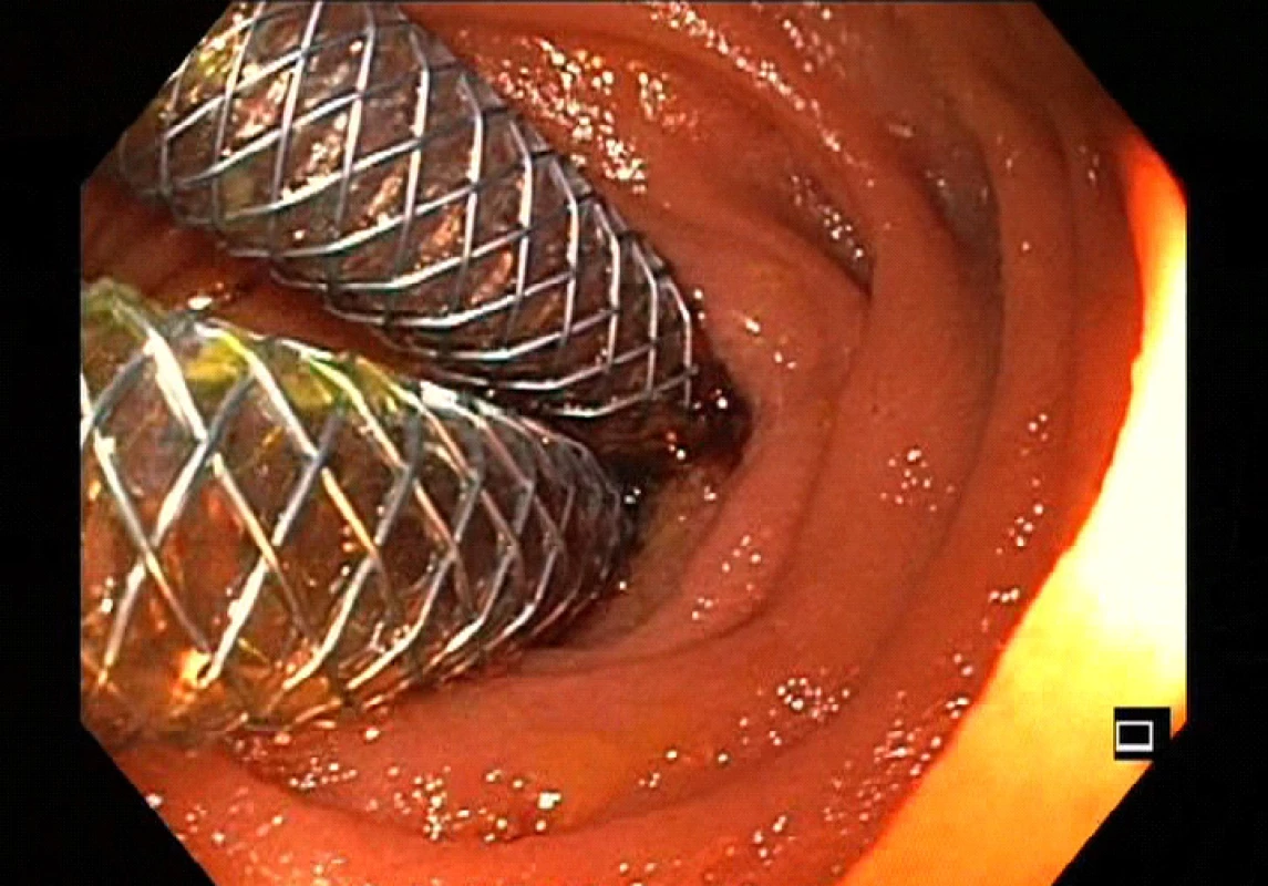 Plně potažené samoexpandibilní metalické stenty
v levém a pravém hepatiku<br>
Fig. 6: Fully covered self-expanding metal stent in left
and right hepatic duct