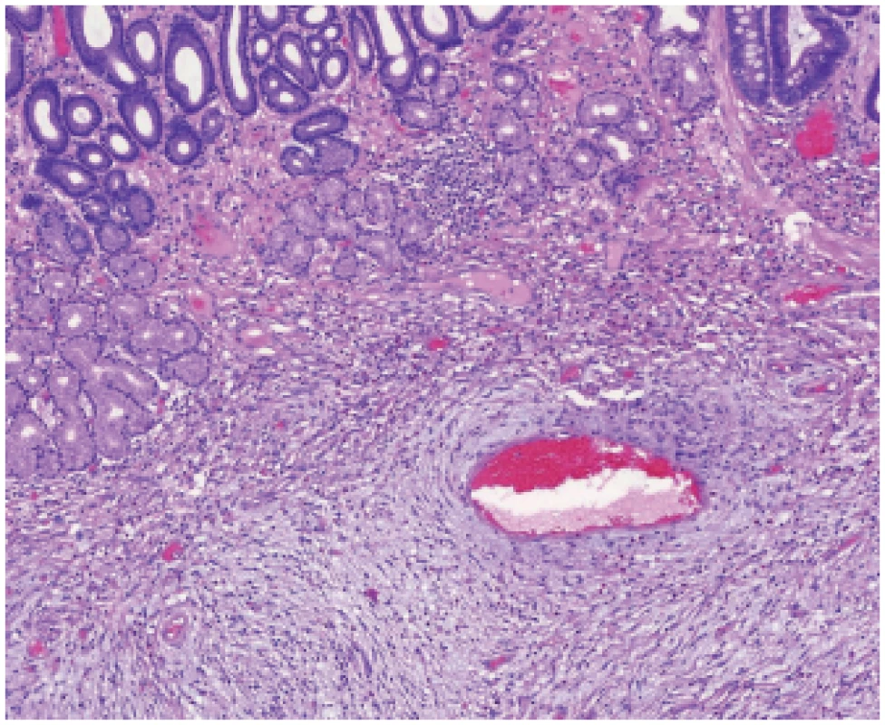 Vaňkův tumor. Pod sliznicí žaludku je patrná proliferace vřetenitých
buněk v edematózním stromatu s příměsí eosinofi lů, která tvoří koncentrické formace okolo cév (HE, 100x).