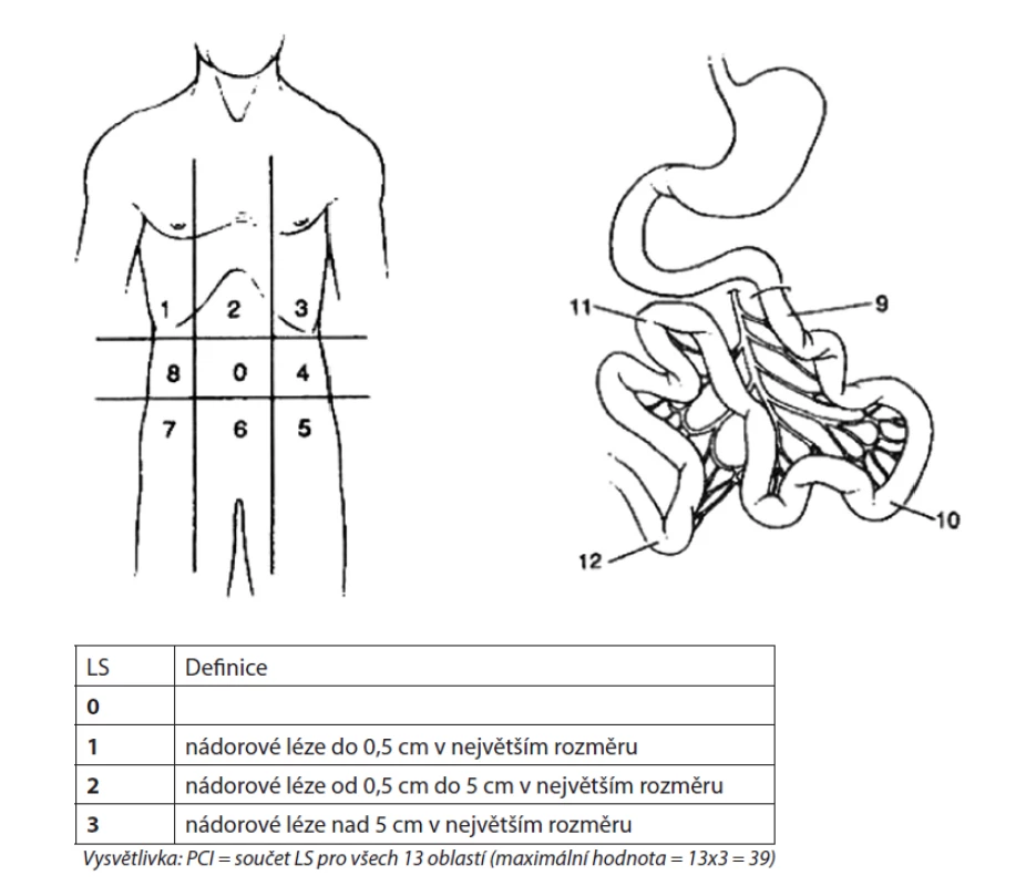Peritoneal cancer index (PCI)<br>
Pro každou vyznačenou oblast se určuje „lesion size“ (LS)<br>
Fig. 2: Peritoneal cancer index (PCI)<br>
Lesion size (LS) is specified for each designated area
