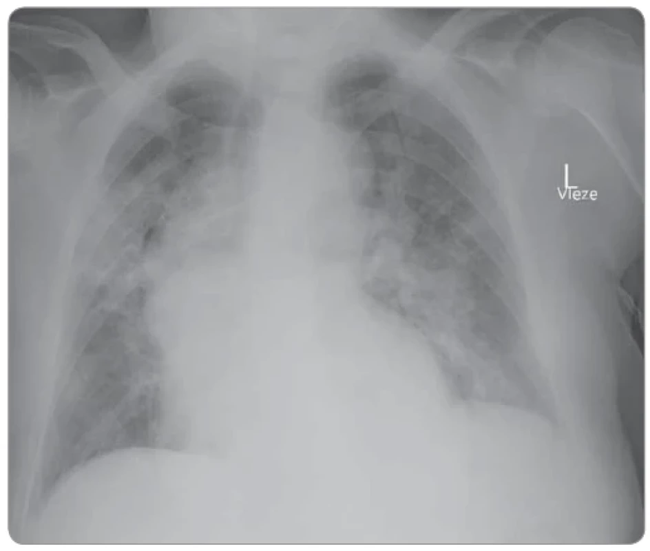 Chest X-ray of patient 1.