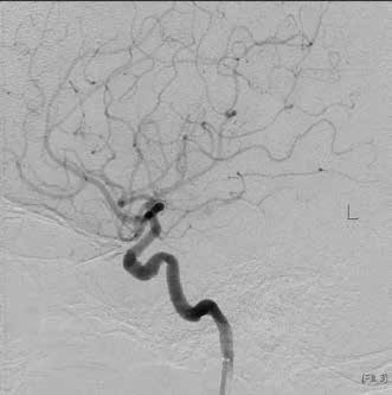 Slowed filling of arteria ophthalmica I. sin