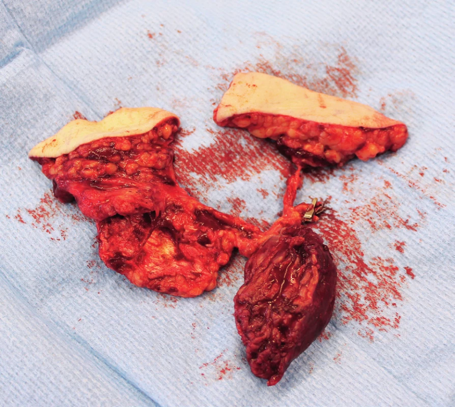MFC multicomponent flap (bone, muscle, skin) provides
a highly vascularized osteogenic tissue that may be moulded or
wrapped in non-union sites of osseous tissue and defect in soft
tissue coverage
