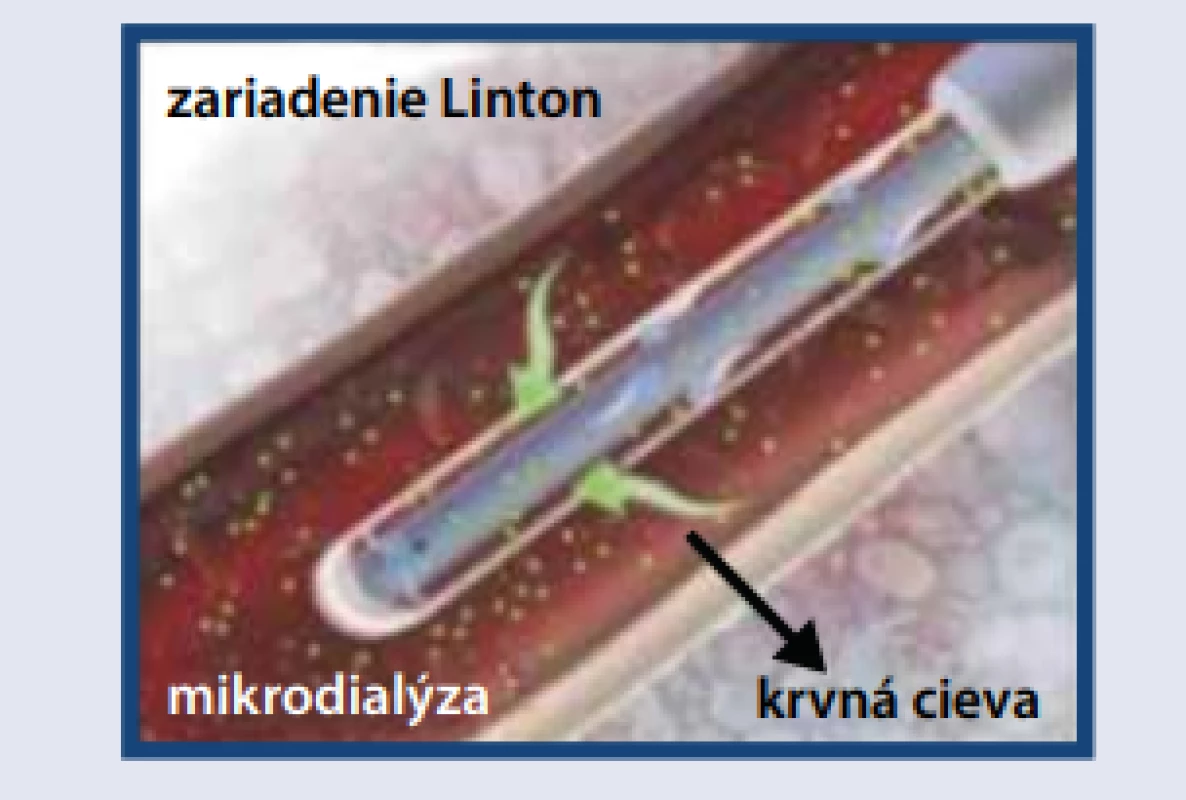 Schematická ilustrácia mikrodialyzačného
katétra pre monitorovanie glykémie [12]
