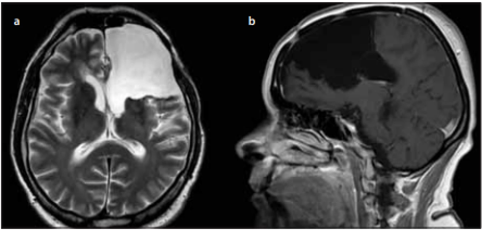 Pooperační MR pacientů po resekcích nízkostupňových gliomů skupiny ANO 
Risk, kde operatér dosáhl maximální možné resekce. <br>
Fig. 5. Postoperative MRI of patients with low grade gliomas in the group ANO Risk, 
when the surgeon was able to achieve maximal possible radical resection. 