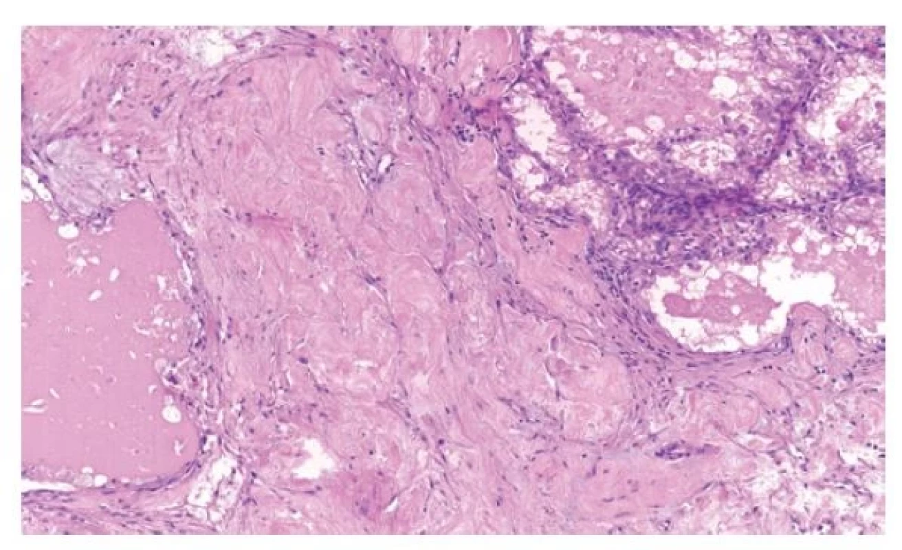 RK s mutací genu ELOC jsou světlobuněčné s nápadným fibromyomatózním
stromatem.