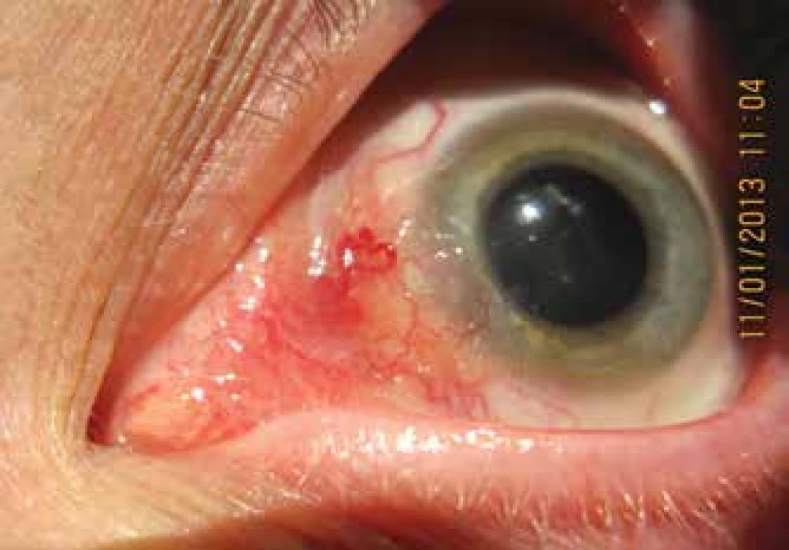 Clinical picture of a patient with inverted type of conjunctival
papilloma in the nasal section of the bulbar conjunctiva (1/2013)