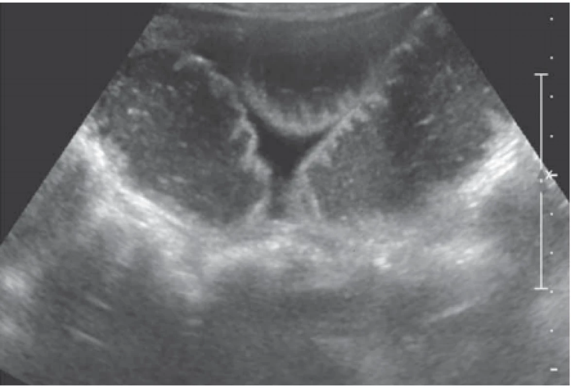 Ultrasonografi cké vyšetření břicha, konvexní, nízkofrekvenční sonda,
dilatované kličky ilea, edém řas, volná tekutina mezikličkově, ileus – operační
nález adheze.
Fig. 10. Ultrasonographic examination of the abdomen, convex, using a low-frequency probe, dilated loops of the ileum, edema of the mucosa, free fl uid between
the intercellular, ileus – surgical fi nding of adhesion.