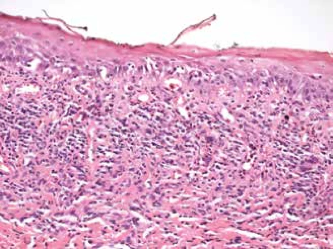 Histological sample from lesion in oral cavity in
patient, sample taken in 2011. Spinocellular epithelium of
mucosa of oral cavity with layer of parakeratosis, vacuolar
degeneration, in subretinal conjunctiva streaked lymphocytic
infiltrate typical of lichen planus