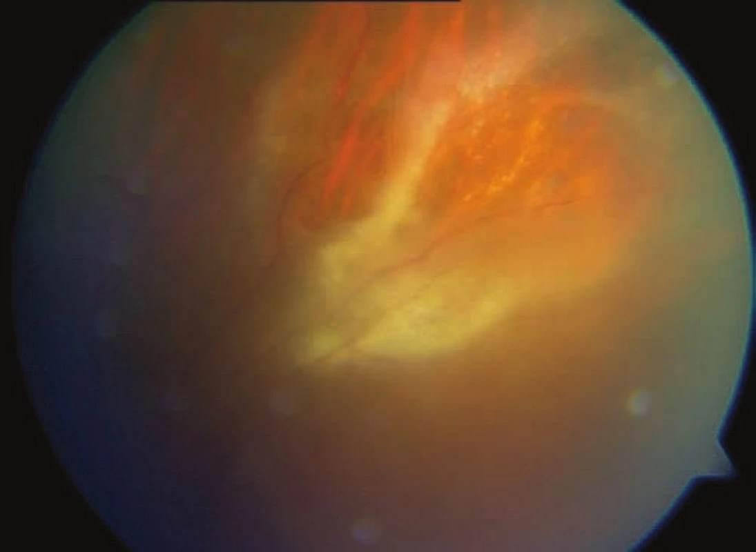 Cytomegalovirus retinitis in a patient with HIV