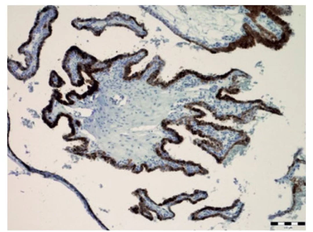 Imunohistochemický průkaz cytokeratin AE1/AE3 (zvětšení 100x).