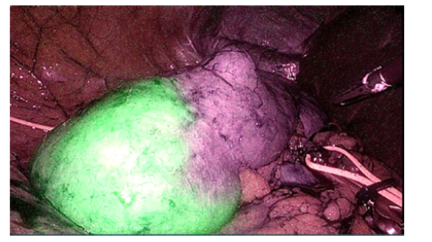Využití ICG (indocyaninové zeleně) k verifikaci
ischemie při selektivním klampování větve renální arterie<br>
Fig. 4. The application of ICG (indocyanine green) to verify
the ischemia during a selective renal artery clamping