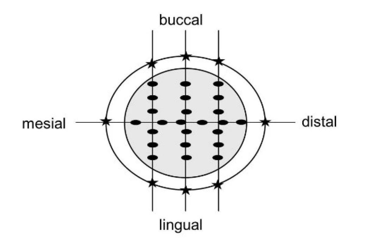 Replicas sectioning plan for standard preparation design (SP) and preparation design with occlusal isthmus (OP): in the bucco-lingual direction (3 times) and in the mesio-distal direction (1 time). With measuring points occlusal (dots, 6 points each slice) marginal (stars, 2 points each slice) and axial (not marked, 2 points each slice)