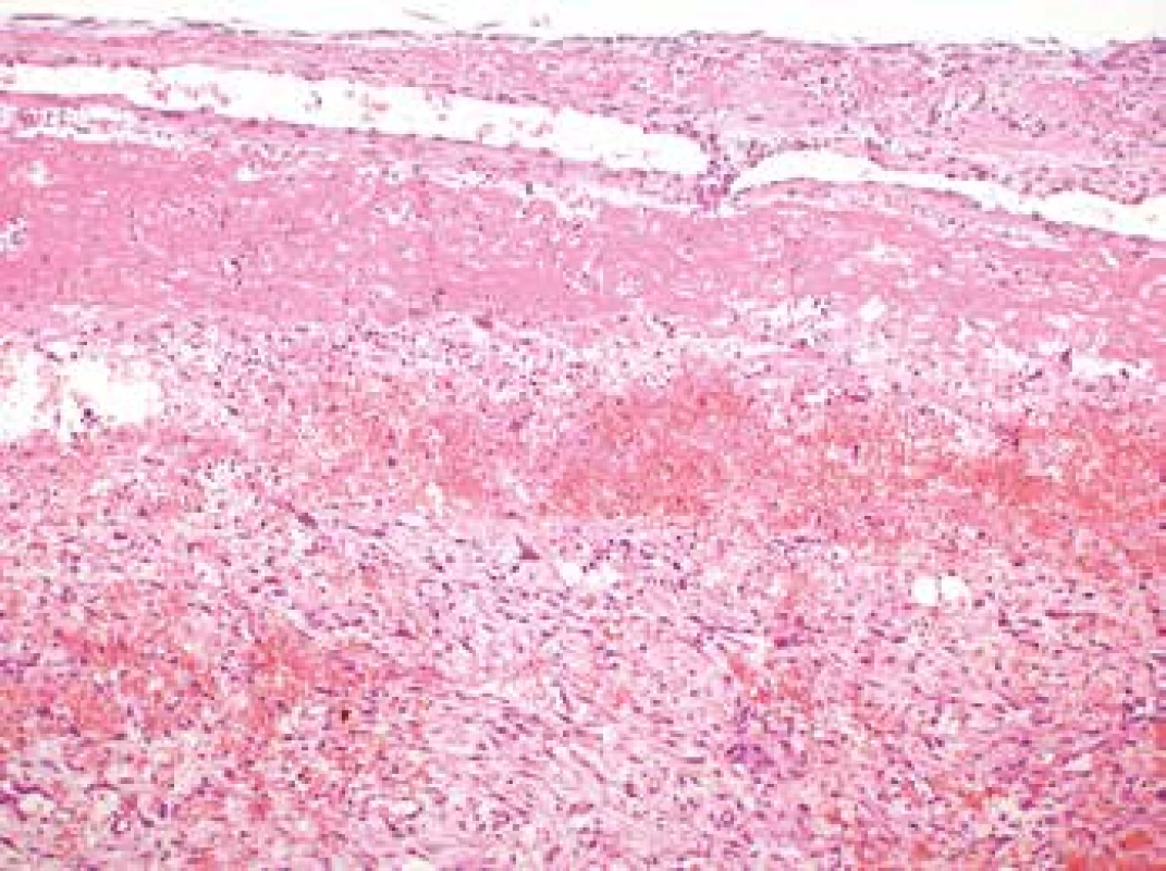 Myofibroplastic proliferation within the aortic wall affecting all the
histological layers of the aorta (H&E, original magnification 100x).