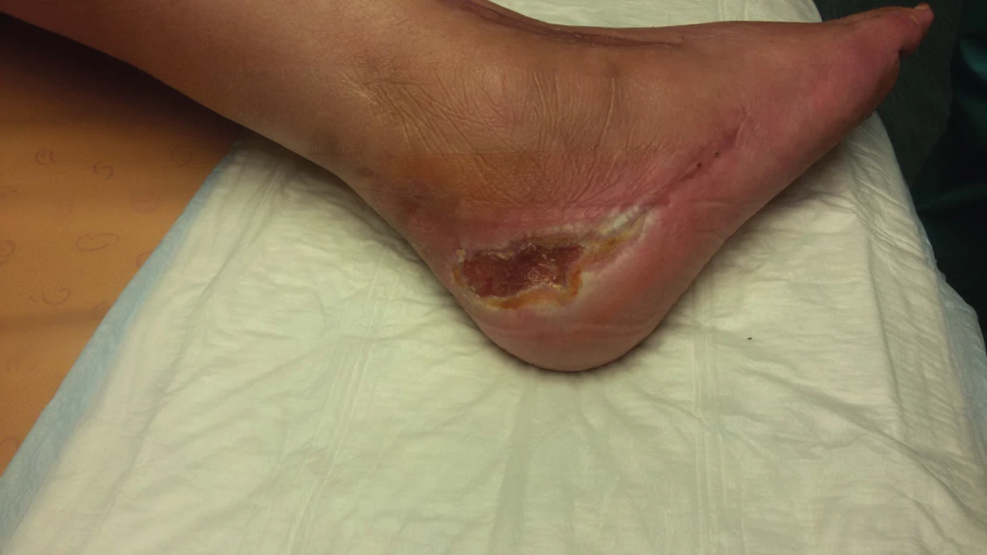 Situation after 6-week outpatient administration of negative
pressure