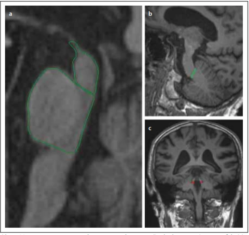 Magnetic resonance parkinsonism index – poměr plochy pontu/mezencefala (a)
násobený poměrem šíří pedunculli cerebellares medii (b) / pedunculli cerebellares
superiores (c).<br>
Fig. 1. Magnetic resonance parkinsonism index – ratio of the area of the pons/midbrain
(a) multiplied by the ratio of the widths of the middle cerebellar peduncle (b) / superior
cerebellar peduncle (c).