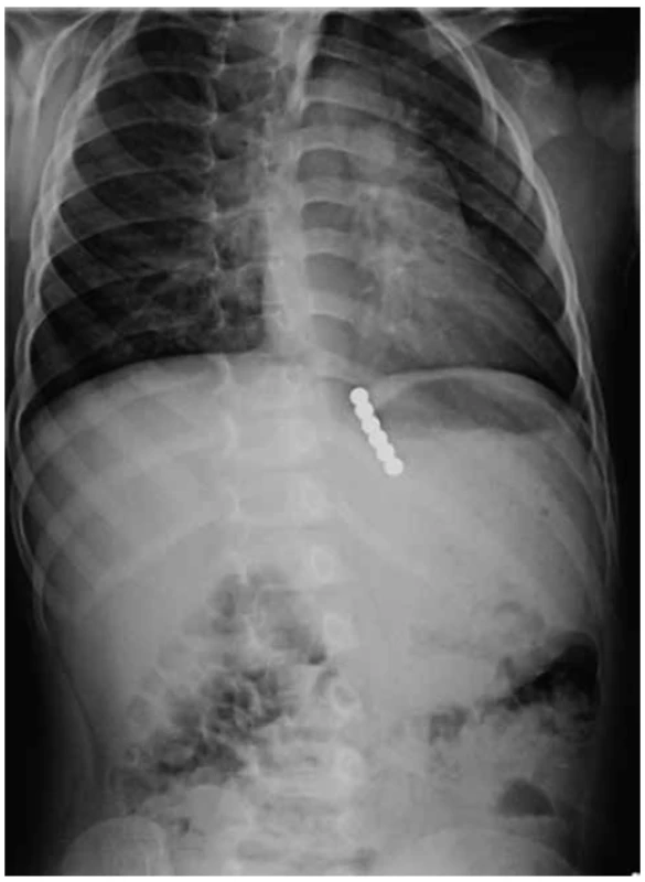 Šest magnetických kuliček, dvě v distálním jícnu,
čtyři v žaludku<br>
Fig. 2. Six magnets; two in the distal oesophagus and
four in the stomach