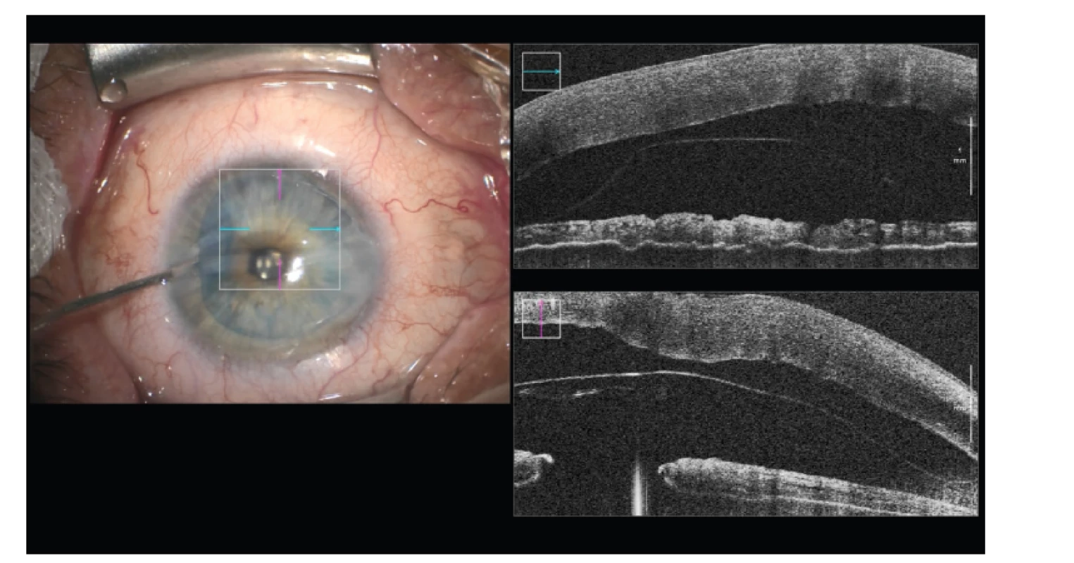 Pozice lamely při DMEK (Descemet Membrane Endothelial Keratoplasty) před
injekcí bubliny vzduchu