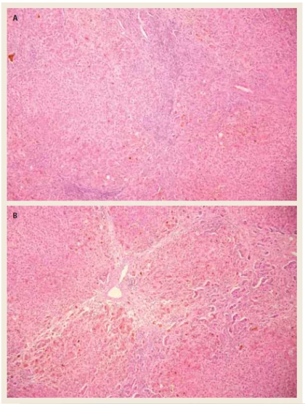 a, b) Histopatologické vyšetření explantátu jater. <br> 
Fig. 2. a, b) Liver explant histopathology.

