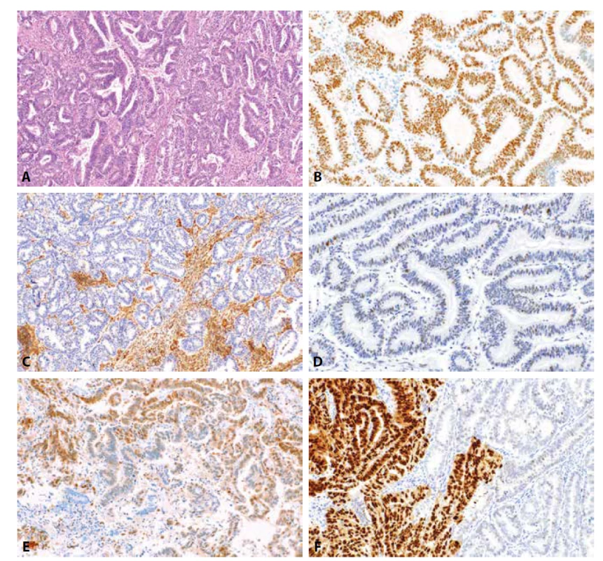 Endometroidní karcinom. Dobře diferencovaný (G1) endometroidní karcinom (HE, 100x). Nádorové buňky vykazují pozitivitu estrogenových
receptorů ve více než 90 % nádorových buněk (2B, 200x), difúzní ztrátu exprese PTEN (2C, 100x) a „wild-type“ expresi p53 (2D, 200x). Středně
diferencovaný endometroidní karcinom s fokální expresí p16 („mozaikovitý“ typ exprese) (2E, materiál z kyretáže, 200x). Středně diferencovaný
endometroidní karcinom s klonálním typem exprese p53 (2F, 200x).