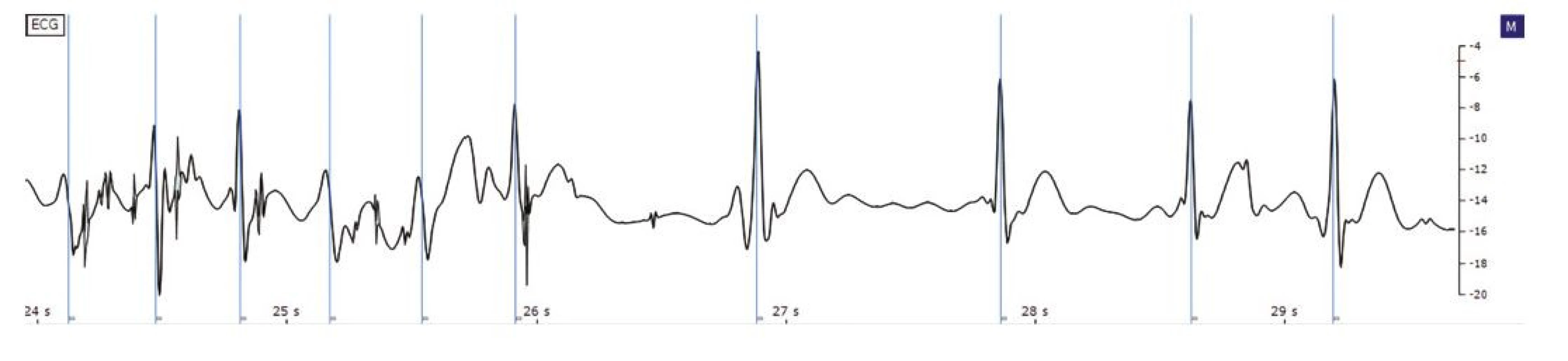 Závěr běhu supraventriukární tachykardie s přechodem do sinusového rytmu, zaznamenaný pomocí nositelné elektroniky (zde hodinky Apple
Watch 6). Vertikály označují QRS komplexy detekované autonomním systémem J.O.S.E.P.H. ze společného projektu MDT, s.r.o., a UPT AV ČR. Detekční model
byl trénován na datech z jiného akvizičního hardware
