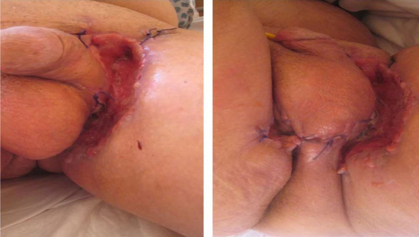 Průběh hojení tři týdny od operace s drobnou recidivou kondylomat<br>
Fig. 2. The course of healing 3 weeks after surgery with apparent small recurrence of condyloma
