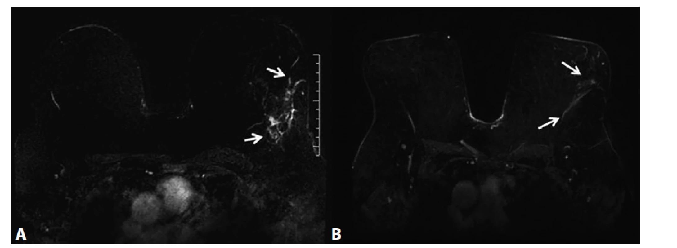 MRM, T1FS ax, kontrastní studie VIBRANT, 3. postkontrastní sekvence, subtrakce − neložiskové sycení ILC<br>
A) Před NCHT. Neložiskové sycení žlázy (NME) v levém prsu odpovídá maligní infiltraci žlázy (rozsah NME vyznačený
dvěma šipkami). B) Po NCHT. Výrazná regrese patologického NME v levém prsu (vyznačeno dvěma šipkami).<br>
Fig. 4: MRI, T1FS ax, VIBRANT contrast study, 3rd post-contrast sequence, subtraction − non-mass enhancement, ILC.<br>
A) Before NCT. Extensive non-mass enhancement (NME) caudally to the ILC lesion, corresponds to malignant disease
in the gland (the extent of NME of the tumour is depicted by two arrows). B) After NCT. Significant regression of pathological
NME of the left breast (depicted by two arrows).