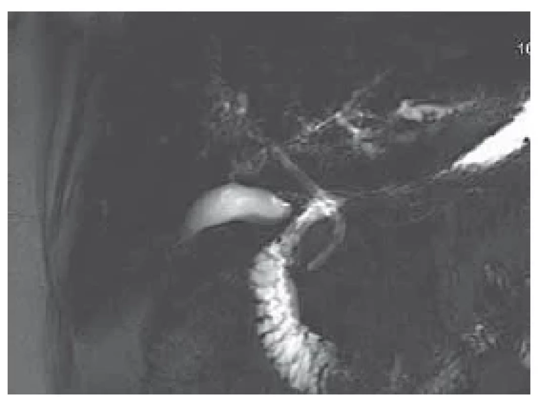 MRCP – nepravidelné intrahepatálne
žlčové cesty, mierne dilatovaný
duktus hepatocholedochus. <br> 
Fig. 1. MRCP – irreguar intrahepatic
bile ducts, slightly dilated hepatocholedochus
duct.