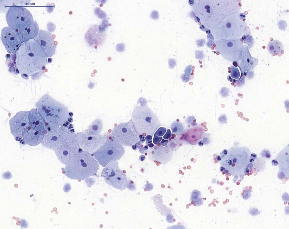 NHGUC (barvení PAP) – přítomny jsou především urotelie povrchové, ojediněle urotelie hlubší (skupina
buněk v centru), na pozadí viditelné neutrofilní granulocyty (segmentované jádro), erytrocyty a autolyticky
změněné blíže nehodnotitelné urotelie<br>
Fig. 1. NHGUC (PAP staining) – superficial urothelial cells and rare deep urothelial cells (group of cells in the
centre) are present, with neutrophils (cells with segmented nuclei), erythrocytes and cytolytic urothelial cells in
the background