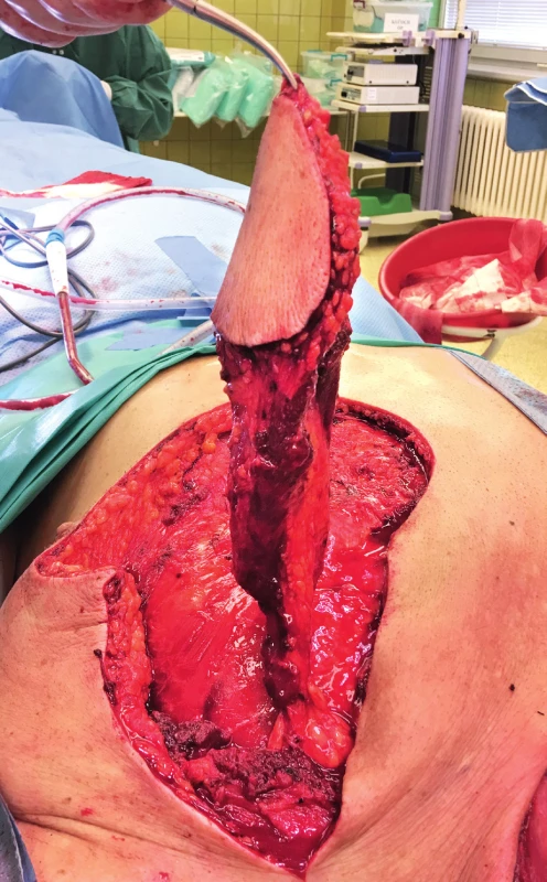 Elevated PPM flap with the pedicle reduced only to the
vessels