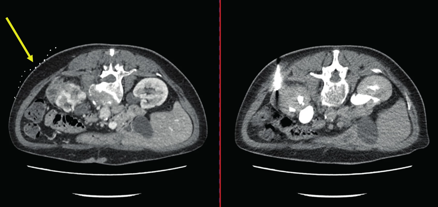 CT, transverzální řez. Žena, 66 let. Vlevo snímek CT před biopsií s popisem solidně-cystického tumoru levé
ledviny a nadledviny s infiltrací retroperitoneálních lymfatických uzlin. Vpravo snímek v průběhu biopsie. Histologicky zánětlivý pseudotumor. Žlutá šipka označuje kontrastní mřížku používanou pro zaměření léze při biopsii<br>
Fig. 3. CT scan, transverse plane. A sixty-six year old female. In the left picture – CT scan prior to the biopsy
with the description of the solid and cystic tumor of the left kidney and adrenal gland with the infiltration of
the retroperitoneal lymph nodes. In the right picture – CT scan during the biopsy. Histologically inflammatory
pseudotumor. Yellow arrow points to the contrast grid which is being used to focus the lession during the biopsy