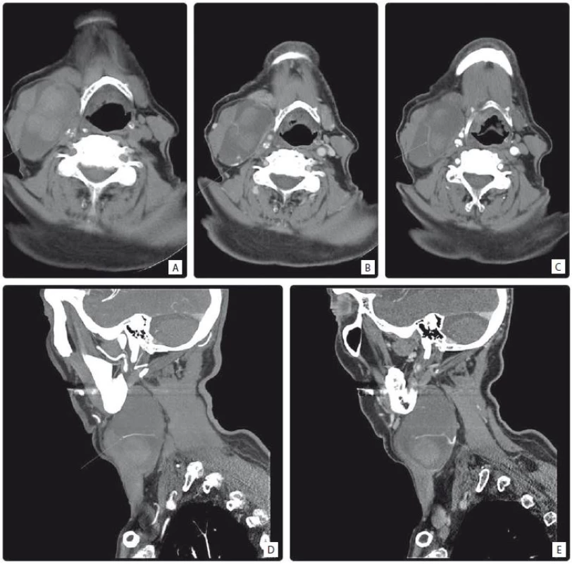 A) A native CT image in the transversal plane – a cyst located among musculus sternocleidomastoideus, submandibular gland and vascular bundle with a inhomogeneous dense content and with a wall slightly irregular in width, 5.5 × 3.3 × 8.5 cm in size. B) Enhacement of the dorsal cyst wall after contrast medium application. C) The vessel in the early arterial phase. D) Sagittal reconstruction in the early arterial phase. E) Sagittal reconstruction in the late arterial phase.