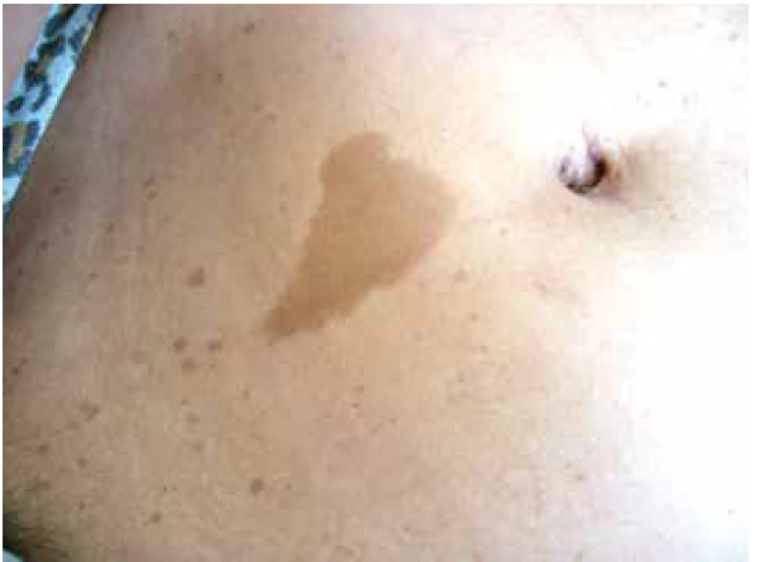 Café-au-lait<br>
Zdroj: Pediatrická klinika LF MU a FN Brno