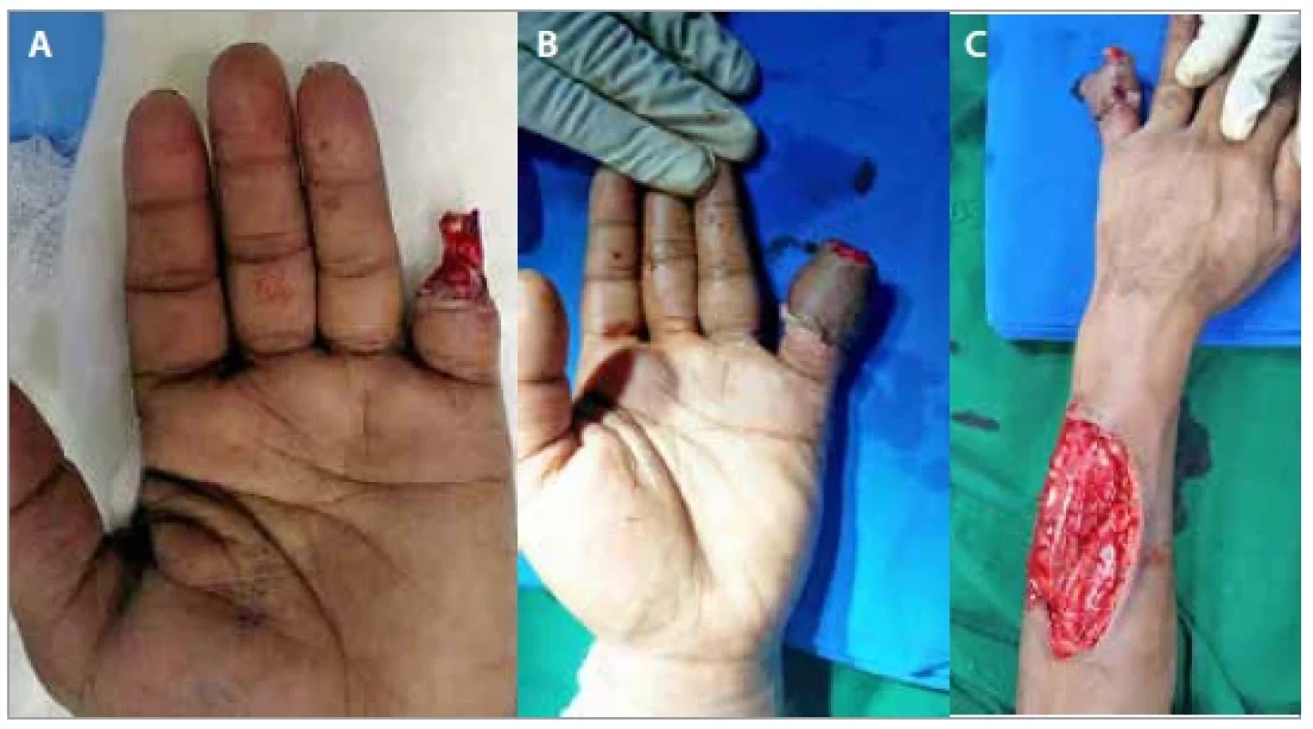 (A) Defect over the middle phalanx with amputation of the distal phalanx.
(B) Immediate post-operative picture after inset; (C) immediate post-operative
picture of the donor site, the dorsal digital vein of the same digit was used.
