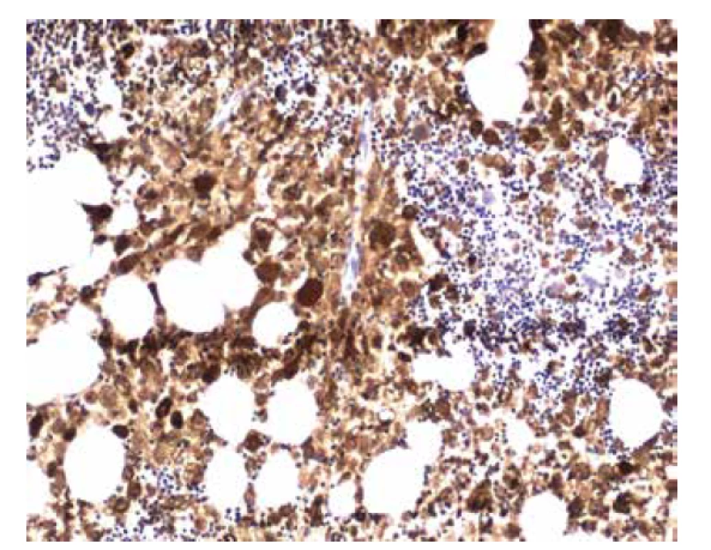 Imunohistochemický průkaz barvení CD68 v gaucherových buňkách
(zvětšení 100x).