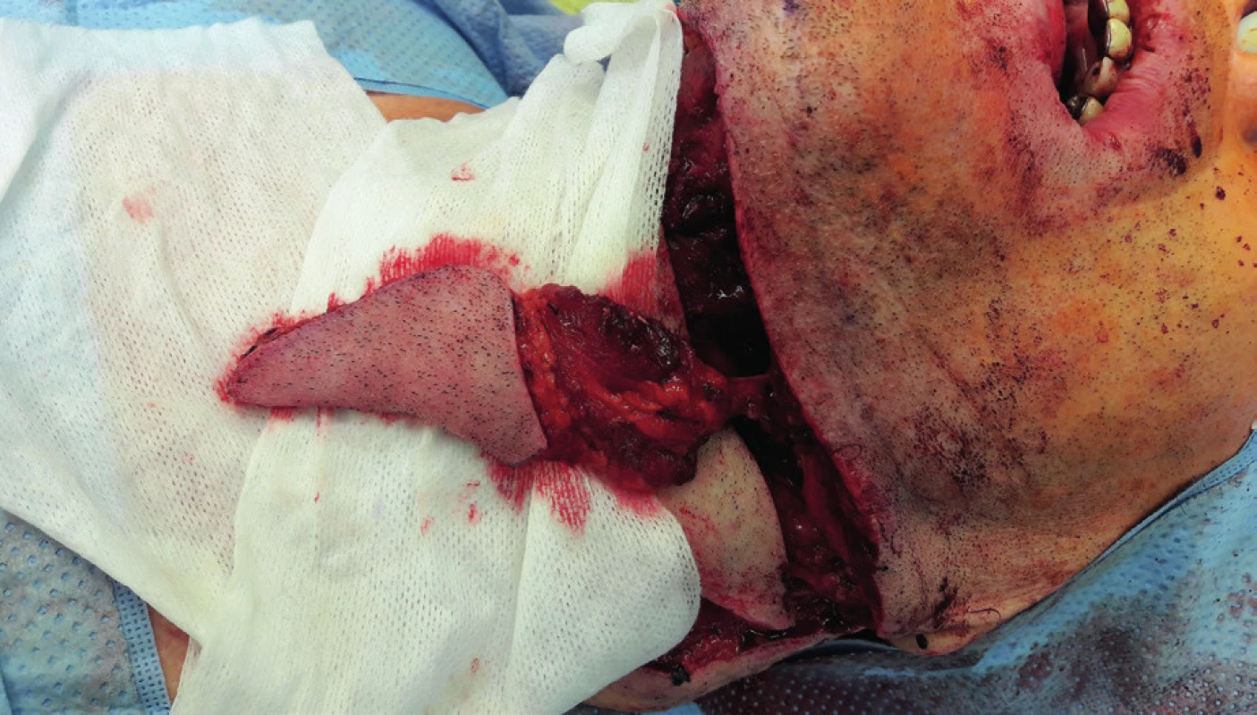 Elevation of the submental flap (author’s archive)